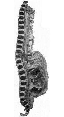 Fig. 219.—Meningo-myelocele of Thoracico-lumbar Region.