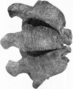 Fig. 226.—Vertebræ from case of Scoliosis, showing alteration in shape of bones.