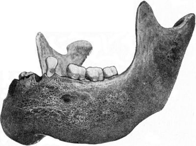 Fig. 248.—Diffuse Syphilitic Disease of Mandible.