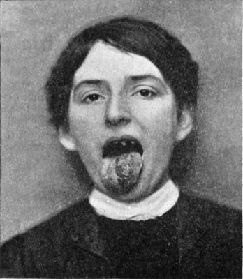 Fig. 258.—Papillomatous Angioma of left side of tongue in a woman aged 26.