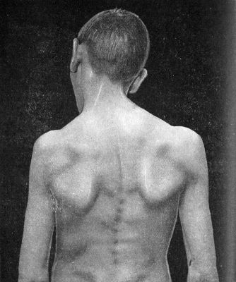 Fig. 272.—Congenital Wry-neck seen from behind to show scoliosis.