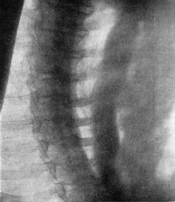 Fig. 285.—Radiogram, after swallowing an opaque meal, in a man suffering from malignant stricture of lower end of Gullet.