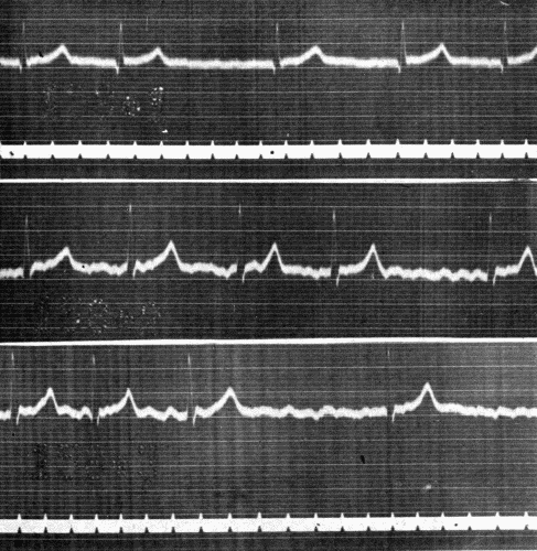 Fig. 41.—Electrocardiogram showing auricular fibrillation in Leads I (upper) and II (middle and lower). (Courtesy of Dr. G. C. Robinson.)