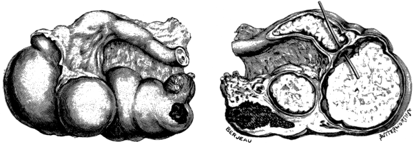 Tuberculous Fallopian Tube and Ovary