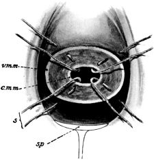 Hegar’s Operation for Supravaginal Elongation of Cervix