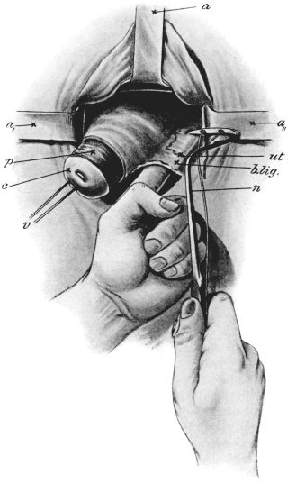 Vaginal Hysterectomy