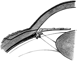 Cataract Extraction