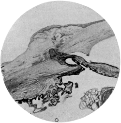 Sympathetic Ophthalmia