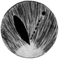 Iridotomy by Ziegler’s Method