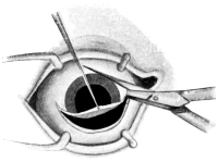 Mules’s Operation