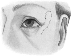 Argyll Robertson’s Operation for Ectropion