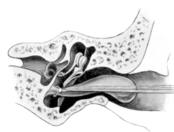 Wilde’s Snare gripping the Neck of Polypus