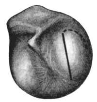 Tympanic Membrane showing Incision in Acute Suppuration of the Middle Ear