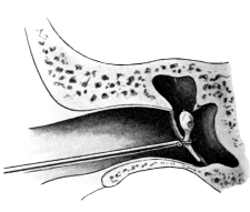 Removal of the Malleus by Wilde’s Snare