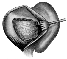 Posterior Portion of Skin Graft covering Outer Surface of Wound Cavity