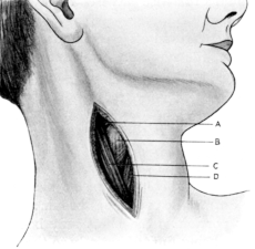 Incision for Exposure of the Internal Jugular Vein