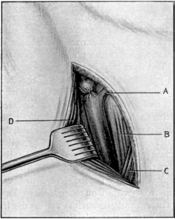 Exposure of the Internal Jugular Vein high up