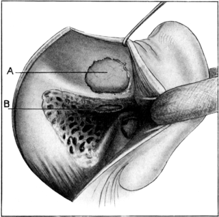 Exploration for a Temporo-sphenoidal Abscess.