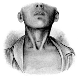 Infrathyreoid Laryngotomy