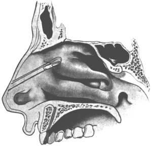 First Step in the Removal of the Anterior End of theMiddle Turbinal