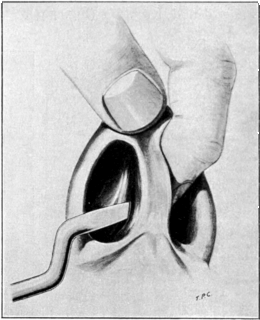 Making the Incision from the Convex Side in Submucous Resection of the Septum