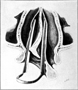 Complete Denudation of the Deviated Septum