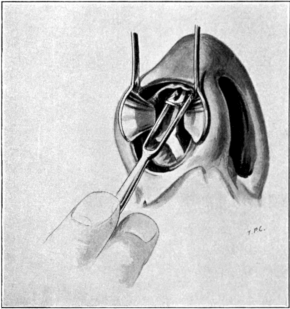 The Method of employing Ballenger’s Swivel Septum Knife