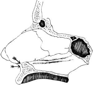 Submucous Resection of the Septum