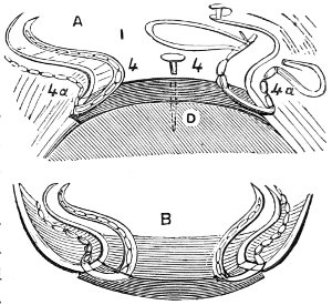 stitching the seam