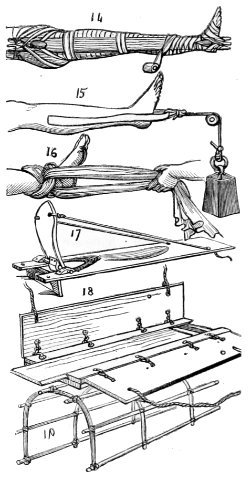 splints 14-19