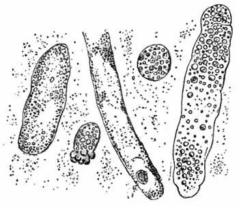 Granular and fatty casts