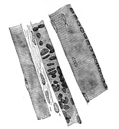 Degeneration of striated muscle Fibres