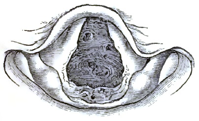 Tuberculous Ulceration of the Trachea