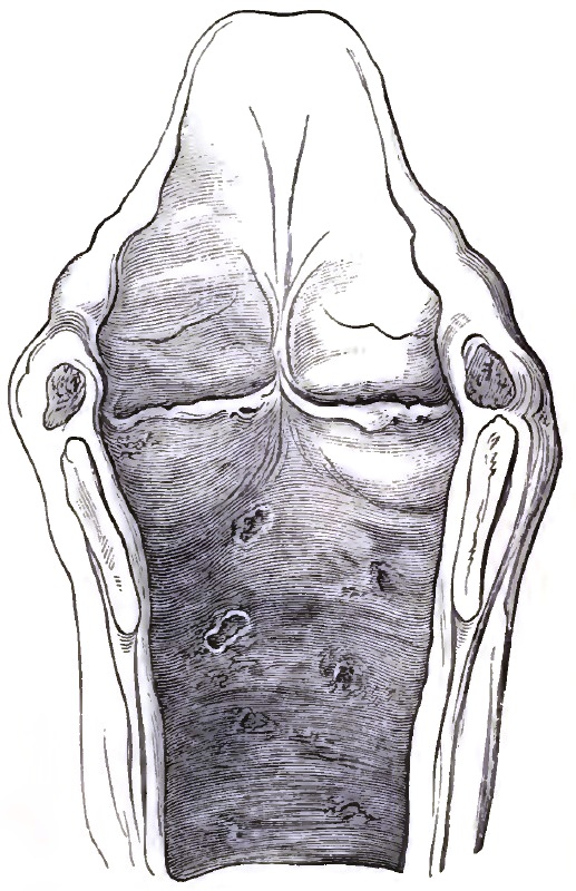 Same case as Fig. 27: post-mortem appearance