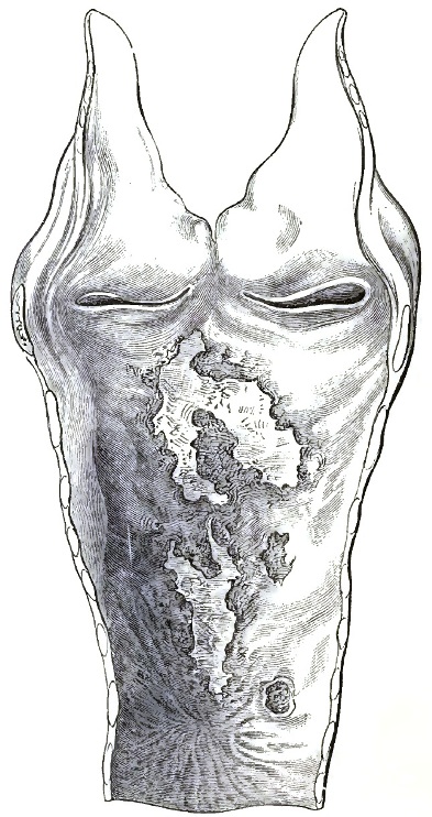 Same case as Fig. 29: post-mortem appearance