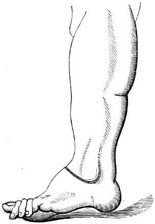 Illustration of lower leg showing where to make an incision.
