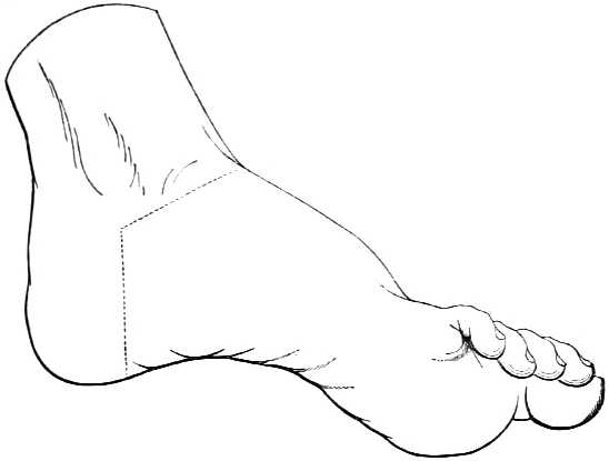 Illustration of foot showing where to make incisions.