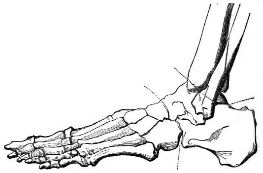 Bones of ankle joint with two marks showing where to cut.