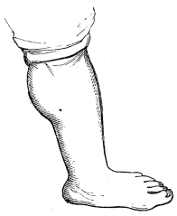 Leg of Negro - side view