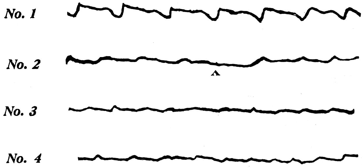 Four tracings of sphygmograph showing changes in blood pressure