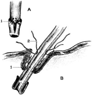The Relation of Parts after
Ricard&rsquo;s Operation of Uretero-cysto-neostomy