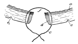 Simon&rsquo;s Operation for the Repair of a Vesico-vaginal Fistula