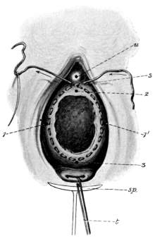 Stoltz&rsquo;s Operation for Cystocele