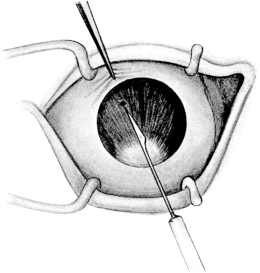 Iridotomy by Ziegler&rsquo;s Method