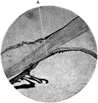 The Angle of the Chamber in
a case of Chronic Glaucoma