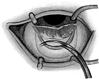 Lagrange Operation
For the Production of a Cystoid Scar in Chronic Glaucoma.