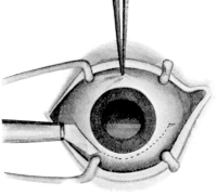 Mules&rsquo;s Operation