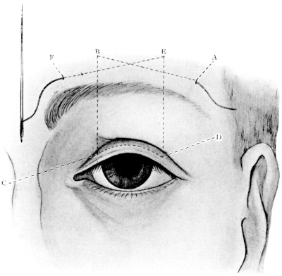 Harman&rsquo;s Operation for Ptosis