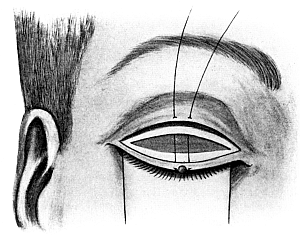 Streatfield&rsquo;s Entropion Operation