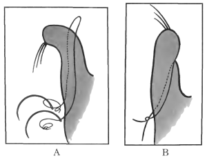Snellen&rsquo;s Sutures